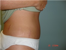 Tummy Tuck After Photo by Howard Perofsky, MD; Macon, GA - Case 8721