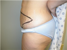 Tummy Tuck Before Photo by Howard Perofsky, MD; Macon, GA - Case 8721