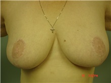 Breast Reduction After Photo by Howard Perofsky, MD; Macon, GA - Case 9155