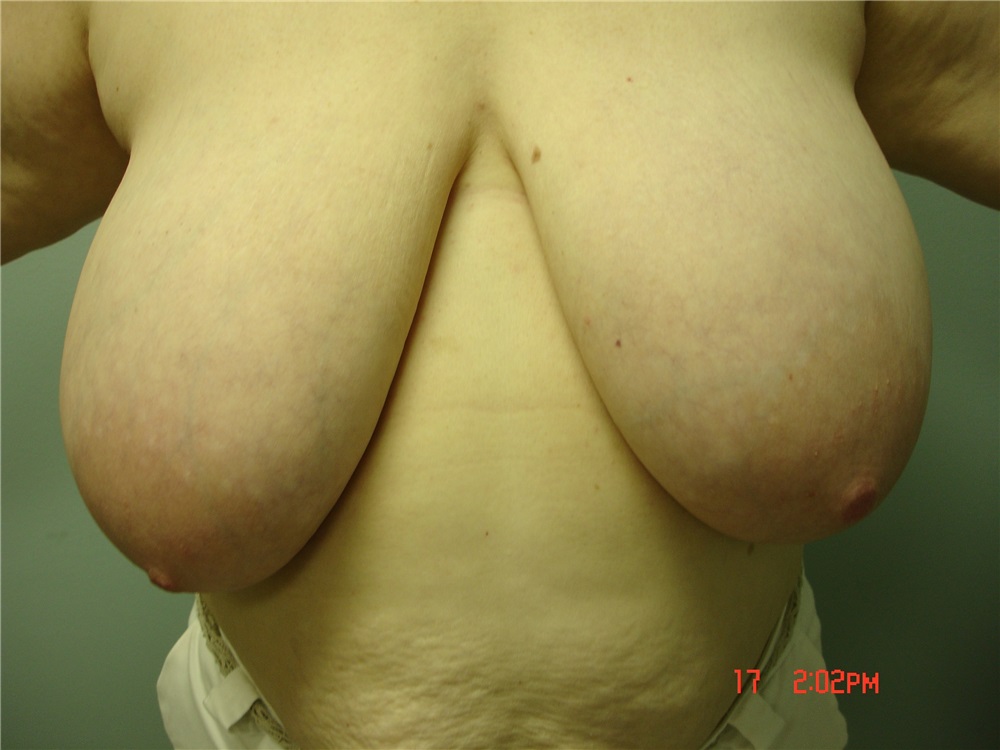 Breast Reduction Before and After Photos by Howard Perofsky, MD; Macon, GA  - Case 9155