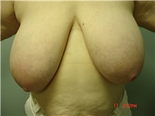 Breast Reduction Before Photo by Howard Perofsky, MD; Macon, GA - Case 9155