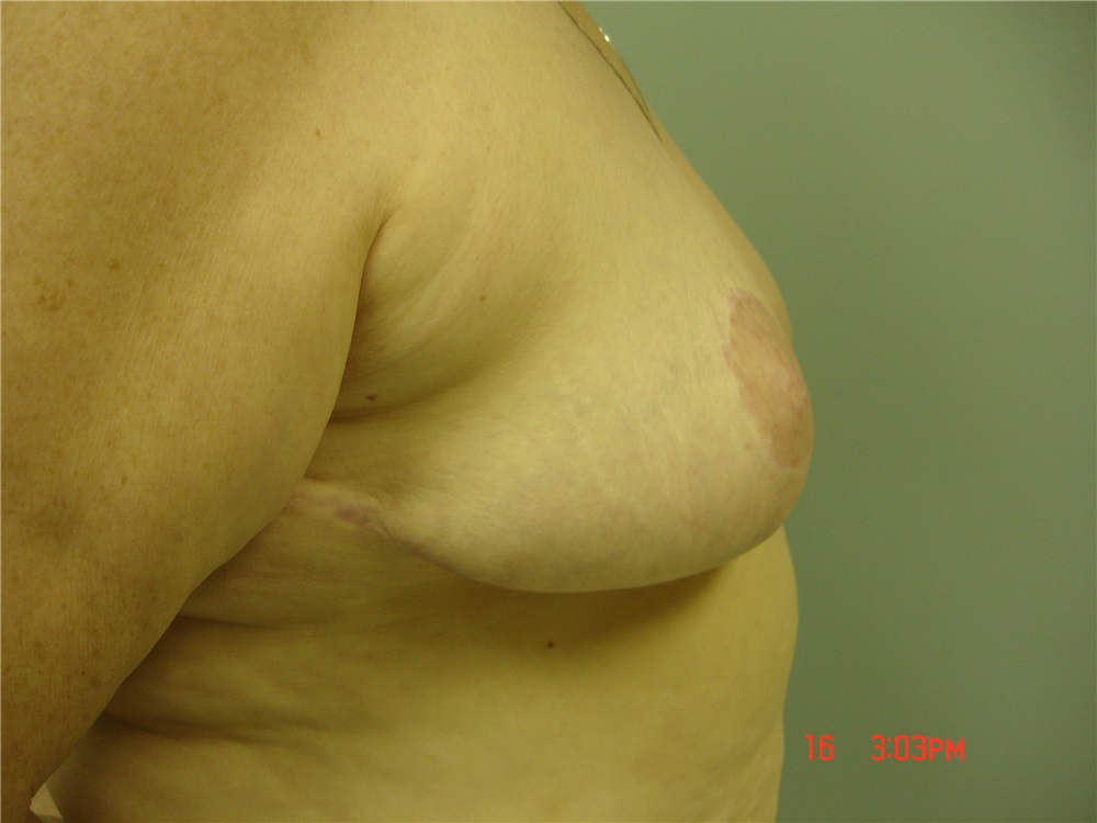https://www1.plasticsurgery.org/include/images/photogallery/cases/5144/9155-68463a_AM.jpg