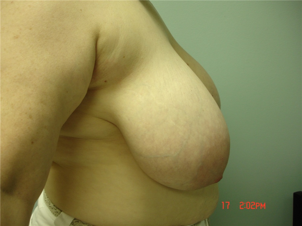 Breast Reduction Before and After Photos by Howard Perofsky, MD; Macon, GA  - Case 9155