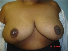 Breast Reduction After Photo by Howard Perofsky, MD; Macon, GA - Case 9215