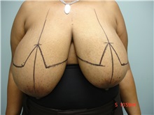 Breast Reduction Before Photo by Howard Perofsky, MD; Macon, GA - Case 9215