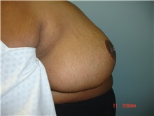 Breast Reduction After Photo by Howard Perofsky, MD; Macon, GA - Case 9215