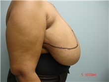 Breast Reduction Before Photo by Howard Perofsky, MD; Macon, GA - Case 9215