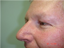Facelift After Photo by Howard Perofsky, MD; Macon, GA - Case 9333