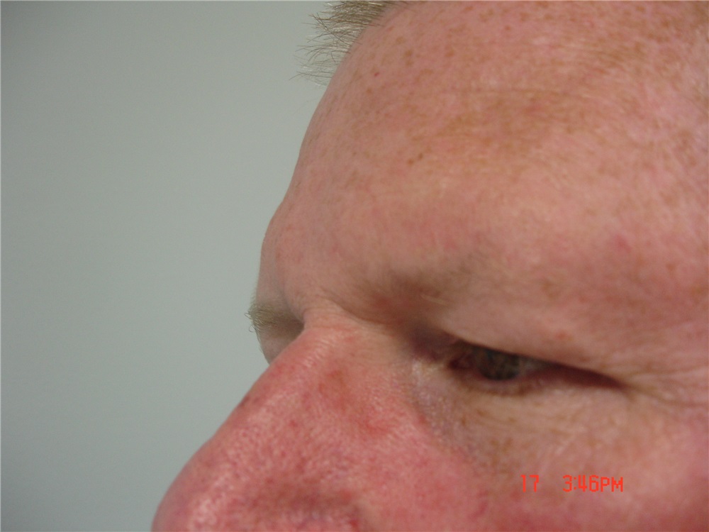 Facelift Before and After Photos by Howard Perofsky, MD; Macon, GA - Case  9333