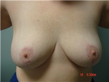 Breast Reduction After Photo by Howard Perofsky, MD; Macon, GA - Case 9335