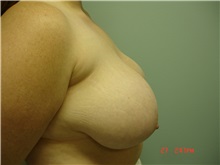 Breast Reduction Before Photo by Howard Perofsky, MD; Macon, GA - Case 9335