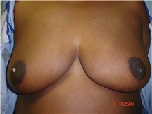 Breast Reduction After Photo by Howard Perofsky, MD; Macon, GA - Case 9462