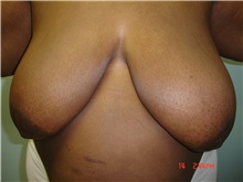 Breast Reduction Before Photo by Howard Perofsky, MD; Macon, GA - Case 9462
