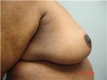 Breast Reduction After Photo by Howard Perofsky, MD; Macon, GA - Case 9485