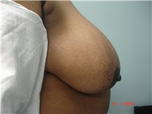 Breast Reduction Before Photo by Howard Perofsky, MD; Macon, GA - Case 9485