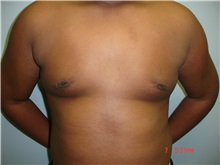 Male Breast Reduction After Photo by Howard Perofsky, MD; Macon, GA - Case 9616