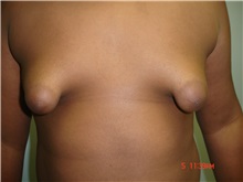 Male Breast Reduction Before Photo by Howard Perofsky, MD; Macon, GA - Case 9616