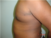 Male Breast Reduction After Photo by Howard Perofsky, MD; Macon, GA - Case 9616