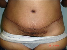 Tummy Tuck After Photo by Howard Perofsky, MD; Macon, GA - Case 9788