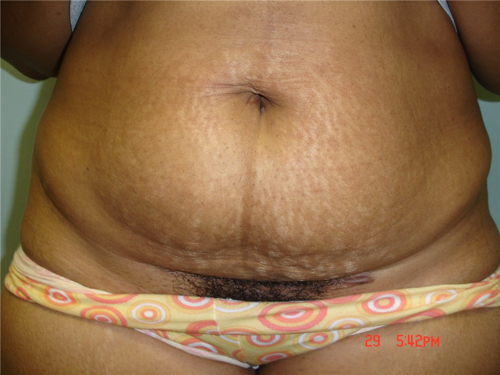 Tummy Tuck Before and After Photos by Howard Perofsky, MD; Macon, GA - Case  9788