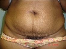 Tummy Tuck Before Photo by Howard Perofsky, MD; Macon, GA - Case 9788
