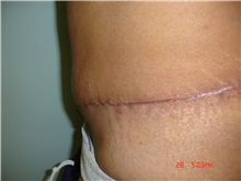 Tummy Tuck After Photo by Howard Perofsky, MD; Macon, GA - Case 9788