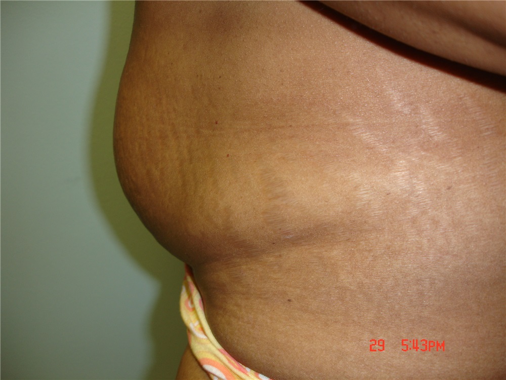 Tummy Tuck Before and After Photos by Howard Perofsky, MD; Macon, GA - Case  9788