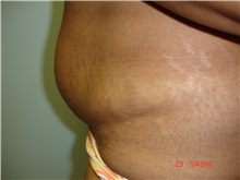 Tummy Tuck Before Photo by Howard Perofsky, MD; Macon, GA - Case 9788