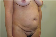 Tummy Tuck Before Photo by Joseph O'Connell, MD; Westport, CT - Case 30998