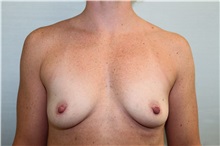 Breast Augmentation Before Photo by Joseph O'Connell, MD; Westport, CT - Case 30999