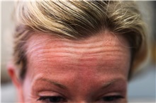 Botulinum Toxin Before Photo by Joseph O'Connell, MD; Westport, CT - Case 31000