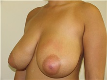 Breast Reduction Before Photo by Joseph O'Connell, MD; Westport, CT - Case 31001