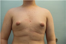 Male Breast Reduction Before Photo by Joseph O'Connell, MD; Westport, CT - Case 31008