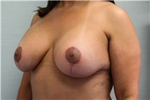 Breast Lift After Photo by Joseph O'Connell, MD; Westport, CT - Case 31010