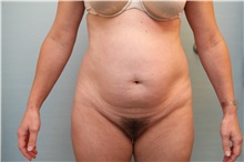 Tummy Tuck Before Photo by Joseph O'Connell, MD; Westport, CT - Case 31014