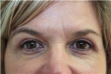 Eyelid Surgery After Photo by Joseph O'Connell, MD; Westport, CT - Case 31027