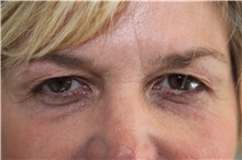 Eyelid Surgery Before Photo by Joseph O'Connell, MD; Westport, CT - Case 31027