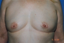Breast Augmentation Before Photo by Dean Sorensen, MD; Boise, ID - Case 23068