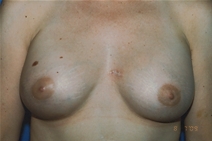 Breast Augmentation After Photo by Dean Sorensen, MD; Boise, ID - Case 23078