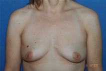 Breast Augmentation Before Photo by Dean Sorensen, MD; Boise, ID - Case 23078