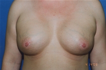 Breast Augmentation After Photo by Dean Sorensen, MD; Boise, ID - Case 23079
