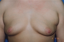 Breast Augmentation Before Photo by Dean Sorensen, MD; Boise, ID - Case 23079