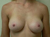 Breast Augmentation After Photo by Daniel Casso, MD; Nassau Bay, TX - Case 10007