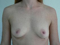 Breast Augmentation Before Photo by Daniel Casso, MD; Nassau Bay, TX - Case 10007