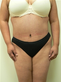 Body Contouring After Photo by Daniel Casso, MD; Nassau Bay, TX - Case 10235