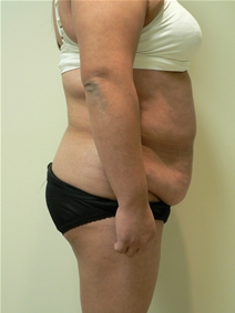 Body Contouring Before Photo by Daniel Casso, MD; Nassau Bay, TX - Case 10235
