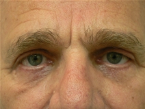 Eyelid Surgery After Photo by Daniel Casso, MD; Nassau Bay, TX - Case 22407