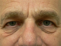 Eyelid Surgery Before Photo by Daniel Casso, MD; Nassau Bay, TX - Case 22407