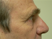 Eyelid Surgery After Photo by Daniel Casso, MD; Nassau Bay, TX - Case 22407