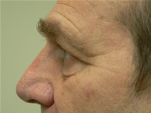Eyelid Surgery Before Photo by Daniel Casso, MD; Nassau Bay, TX - Case 22407